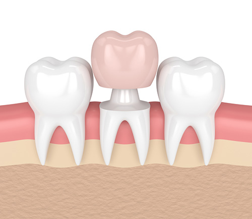 Dental Crown